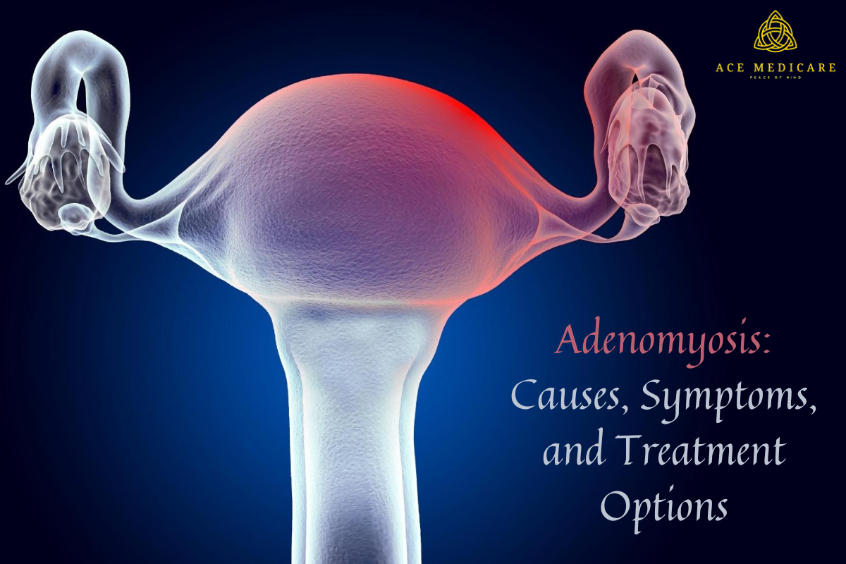 Adenomyosis: Causes, Symptoms, and Treatment Options